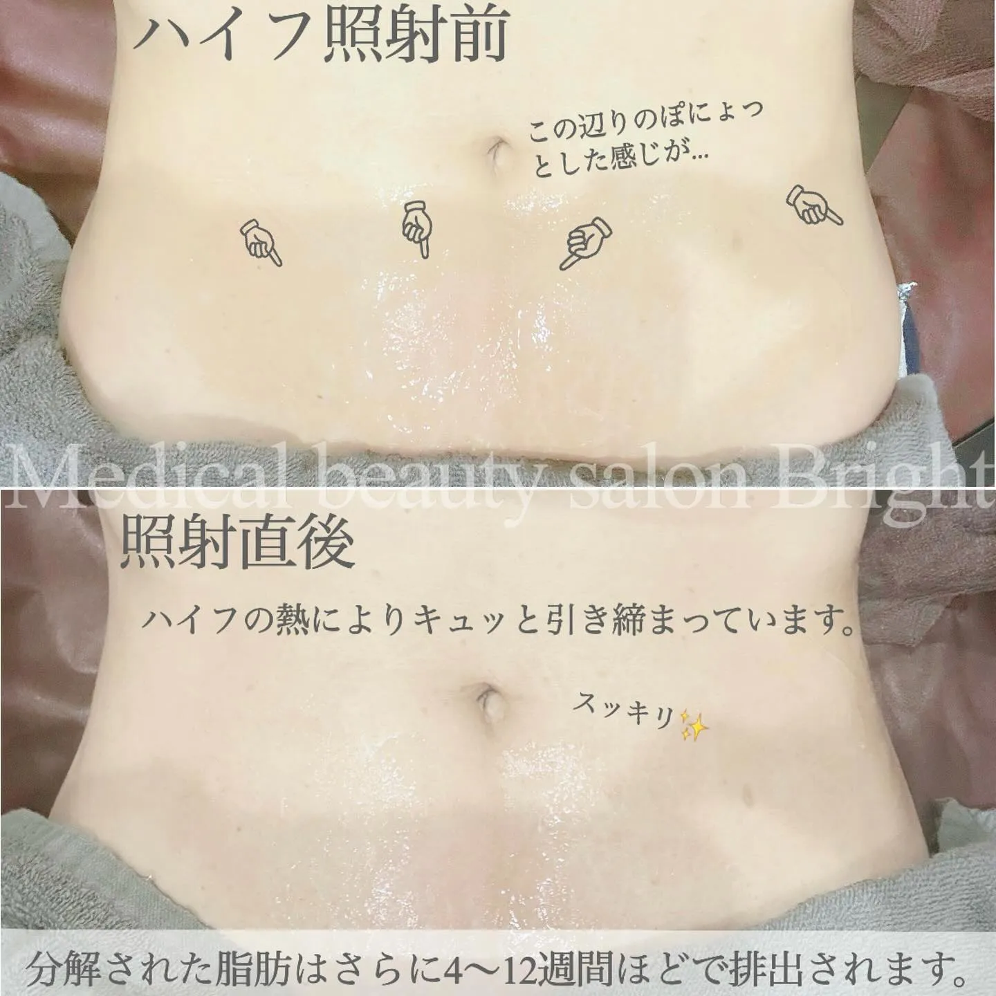 ＼　気になる部分を狙いうち！ボディハイフ✨　／