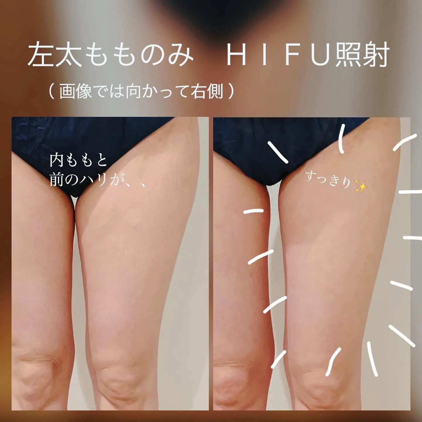 ＼　太ももにハイフ当てるとどうなる？　／