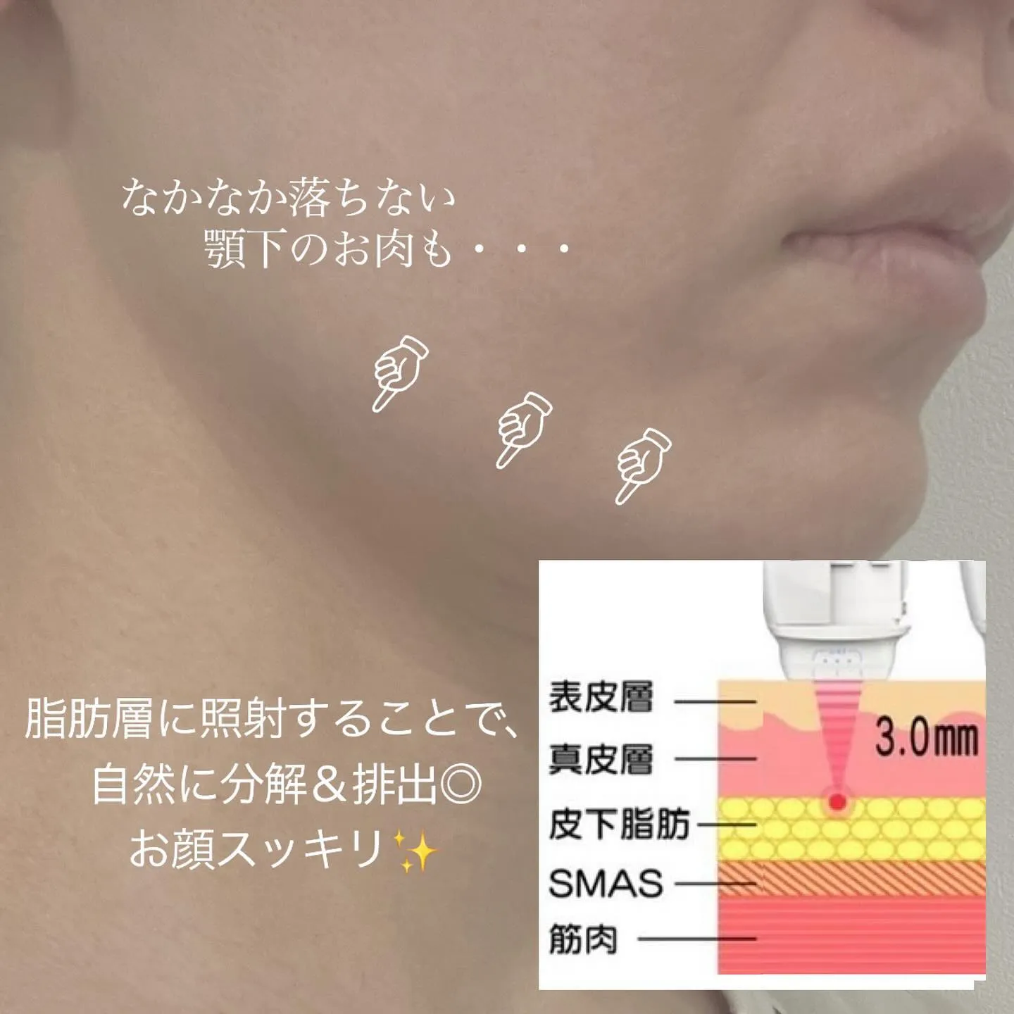 ＼　顔痩せしたい方におすすめのハイフ　／