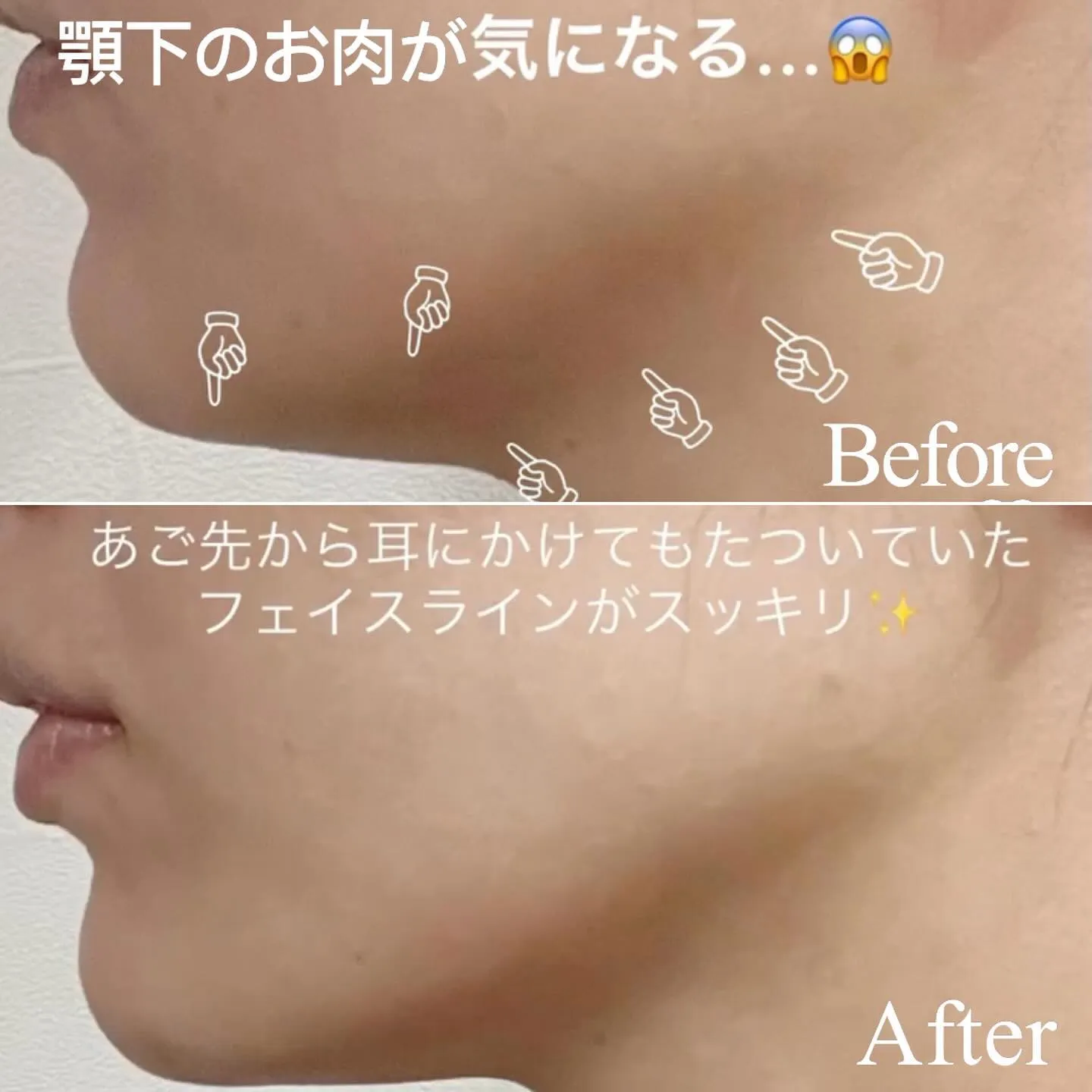 ＼　顔痩せしたい方におすすめのハイフ　／